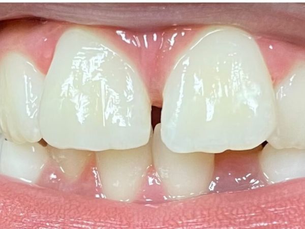 After pediatric dentistry treatment
