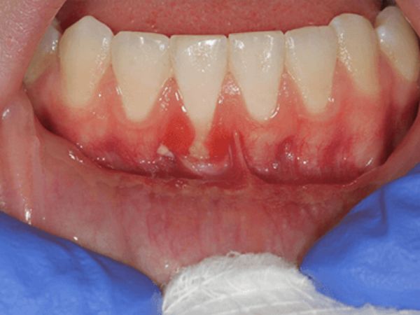 Before gum treatment